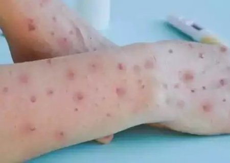 Bebê de dois anos testa positivo para Monkeypox em MS