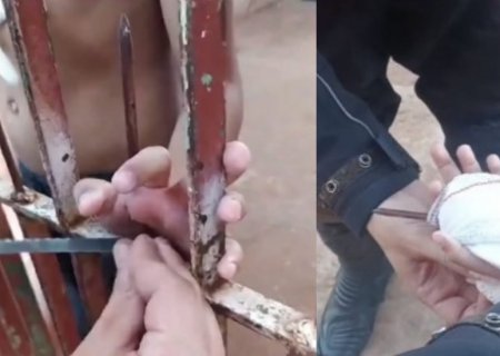 Criança que teve lança de portão fincada na mão passa por cirurgia