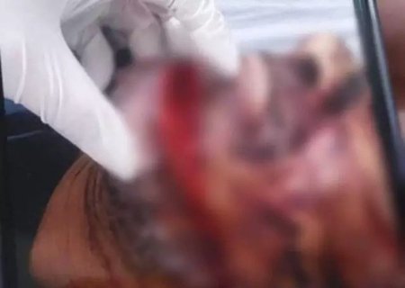 Homem é esfaqueado pela esposa, tem mão amputada e cabeça aberta