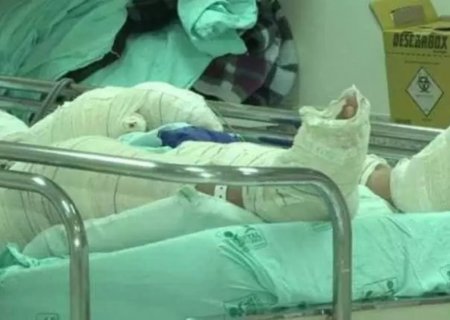 Mulher morre na Santa Casa após ter corpo queimado em acidente com chapa de bife em MS