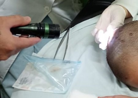 Menina de 7 anos é internada com larvas no couro cabeludo; mãe é investigada por maus-tratos em MS