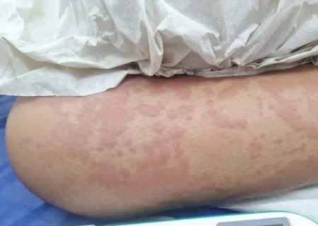 Suspeita de contaminação com detergente Ypê é descartada